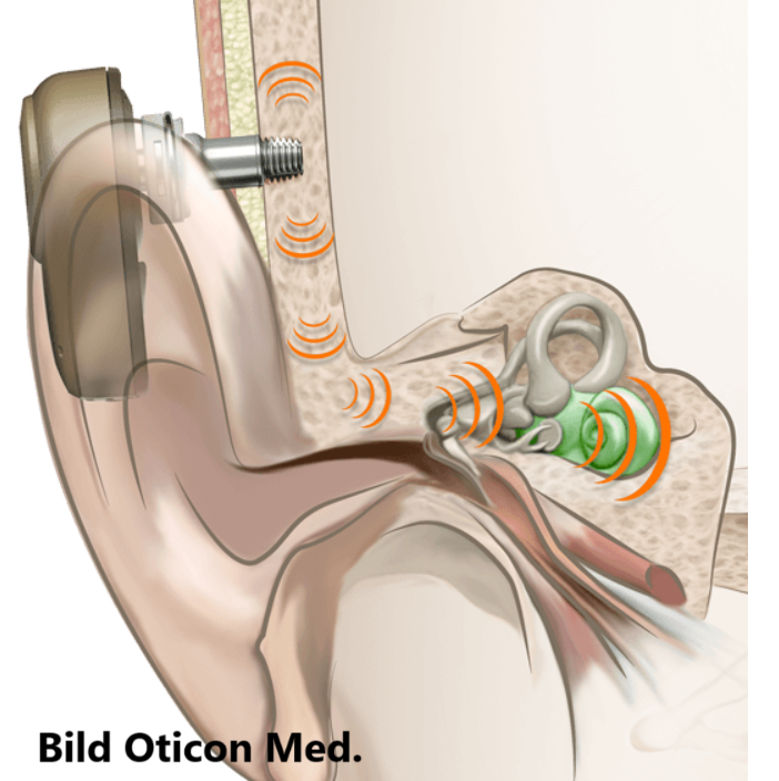 Bone Anchored Device von OTICON
